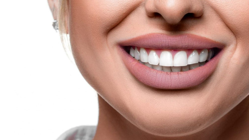 hollywood-smile-dents-limees-danger-dentiste-algerie